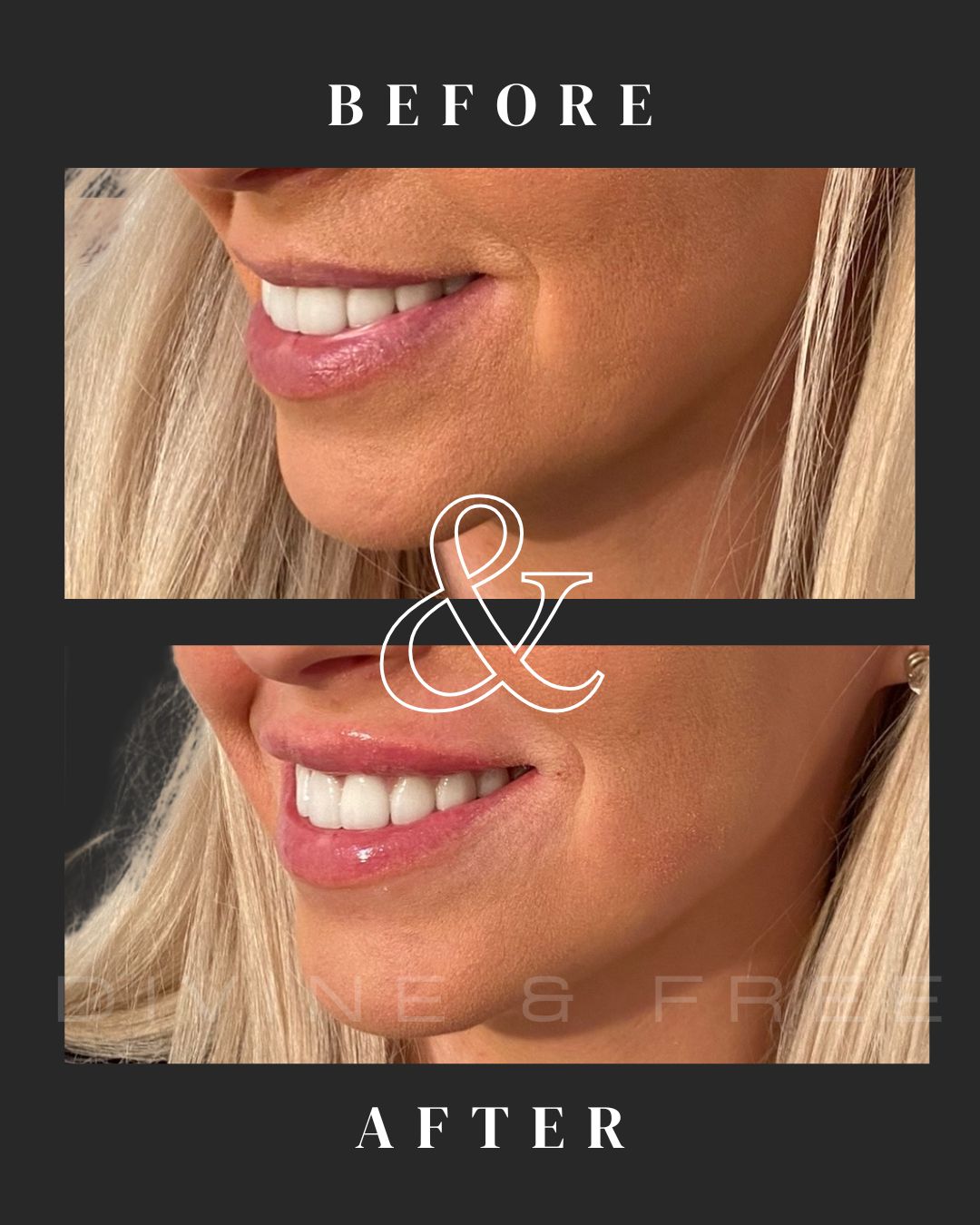 Cosmetic Filler Full Syringe